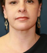 Neck Liposuction San Diego Case 18 - after - side