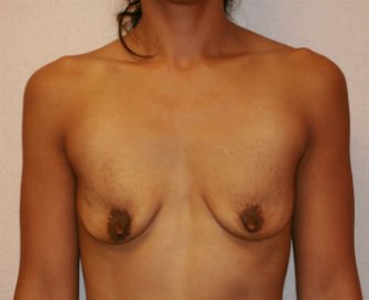 Breast Augmentation San Diego Case 51 - before - front
