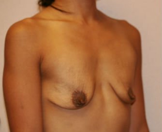 Breast Augmentation San Diego Case 51 - before - oblique