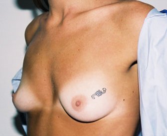 Breast Augmentation Case 2 - before - angle