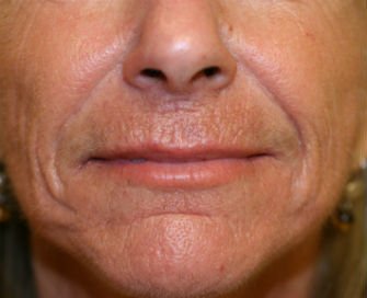 Filler in Nasal Labial Folds-Creases San Diego - before - front