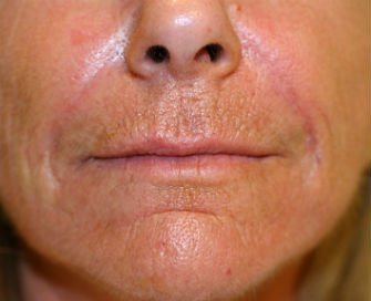 Filler in Nasal Labial Folds-Creases San Diego - after - front