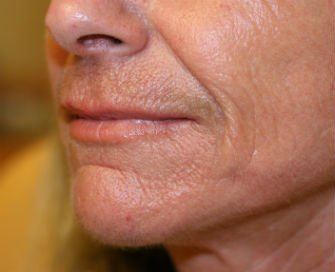 Filler in Nasal Labial Folds-Creases San Diego - before - oblique