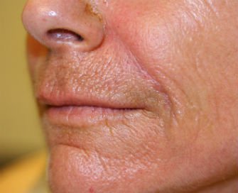 Filler in Nasal Labial Folds-Creases San Diego - after - oblique