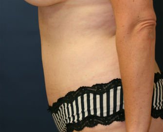 Tummy Tuck San Diego Case 32 - after - side