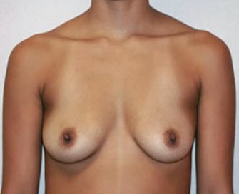 Breast Augmentation Case 1 - before - front