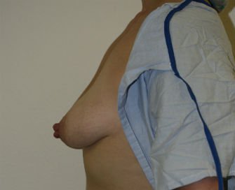 Breast Lift San Diego Case 13 - before - side