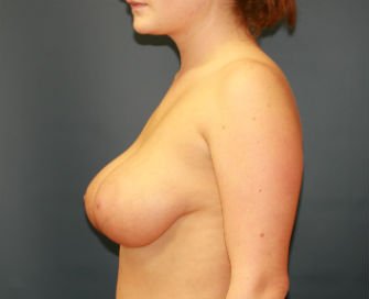 Breast Augmentation San Diego Case 52 - before - side