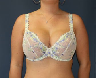Breast Augmentation San Diego Case 52a - after - front