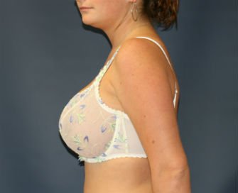 Breast Augmentation San Diego Case 52a - after - side