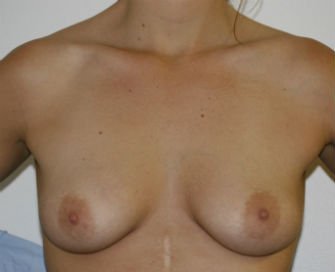 Breast Augmentation 34a - before - front