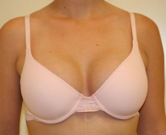 Breast Augmentation 34a - after - front