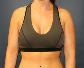 Breast Augmentation San Diego Case 53a - after - front