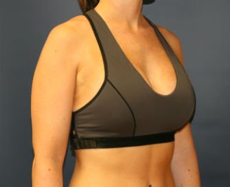 Breast Augmentation San Diego Case 53a - after - oblique