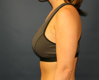 Breast Augmentation San Diego Case 53a - after - side