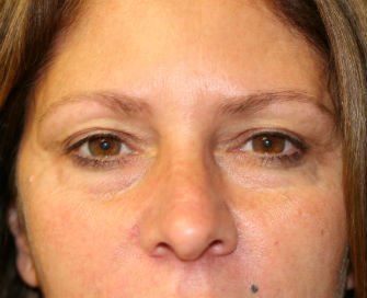 Eyelid Surgery San Diego Case 37 - before - front
