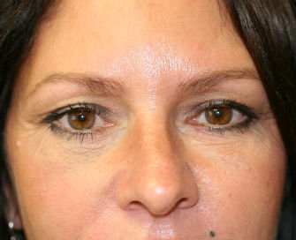 Eyelid Surgery San Diego Case 37 - after - front