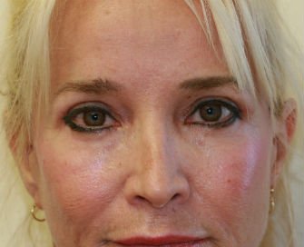 Eyelid Surgery San Diego Case 38 - after - front