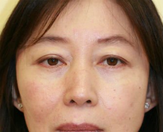 Eyelid Surgery San Diego Case 39 - before - front