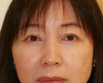 Eyelid Surgery San Diego Case 39 - after - front