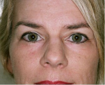 Eyelid Surgery San Diego Case 40 - after - front