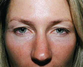Eyelid Surgery San Diego Case 41 - before - front