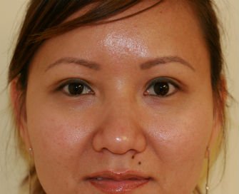 Eyelid Surgery San Diego Case 42 - after - front