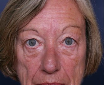 Eyelid Surgery San Diego Case 43 - before - front