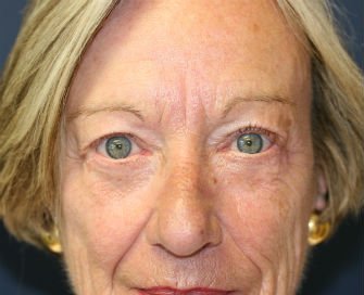 Eyelid Surgery San Diego Case 43 - after - front