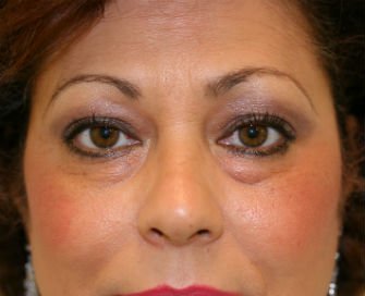 Eyelid Surgery San Diego Case 44 - before - front