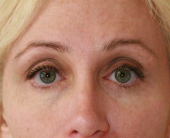 Eyelid Surgery San Diego Case 45 - before - front