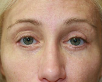 Eyelid Surgery San Diego Case 45 - after - front