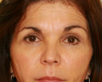 Eyelid Surgery San Diego Case 46 - after - front