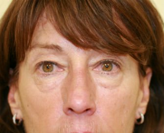 Eyelid Surgery San Diego Case 47 - before - front