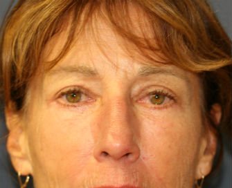 Eyelid Surgery San Diego Case 47 - after - front