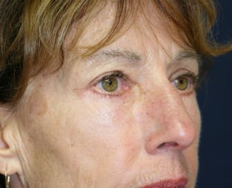 Eyelid Surgery San Diego Case 47 - after - oblique