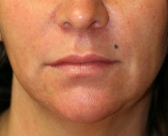 Lip Augment San Diego 10 - before - front