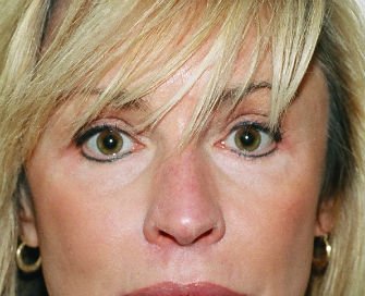 Eyelid Surgery San Diego Case 48 - before - front