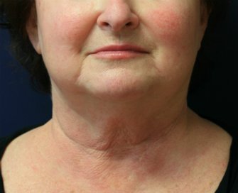 Necklift San Diego Case 19 - before - side
