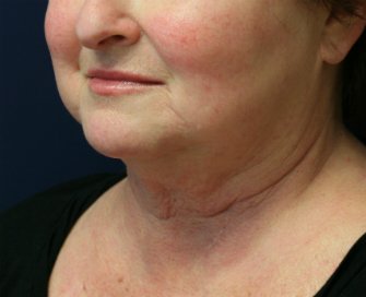 Necklift San Diego Case 19 - before - oblique