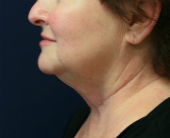 Necklift San Diego Case 19 - before - front
