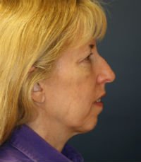 Facelift San Diego Case 17 - before - side