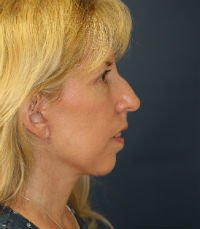 Facelift San Diego Case 17 - after - side