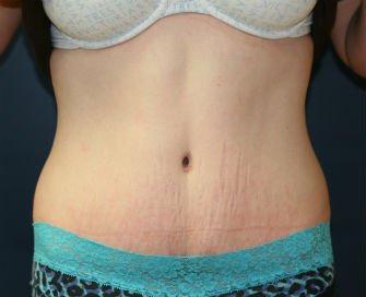 Tummy Tuck San Diego Case 33 - after - front