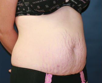 Tummy Tuck San Diego Case 33 - before - oblique