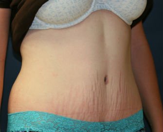 Tummy Tuck San Diego Case 33 - after - oblique
