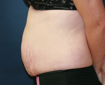 Tummy Tuck San Diego Case 33 - before - side
