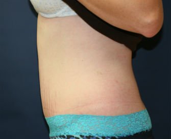 Tummy Tuck San Diego Case 33 - after - side