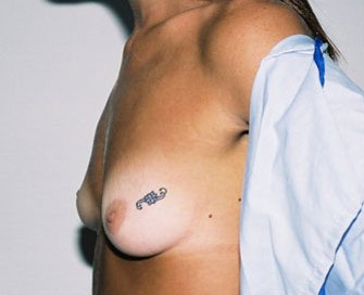Breast Augmentation Case 2 - before - side