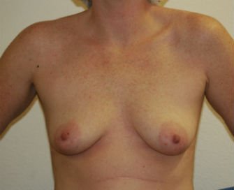 Breast Augmentation San Diego Case 55 - before - front